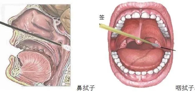 鼻咽拭子采集,你需要注意些什么?