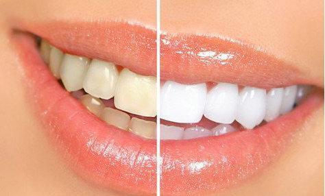 军医科普牙齿颜色异常及美容换色治疗