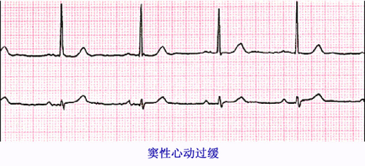 窦性心律是什么病?