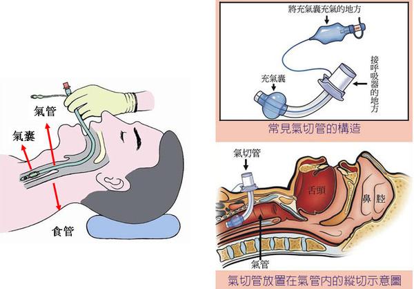 右侧气管食管沟图片